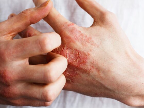 Vitamin D Might Ease the Agony of Psoriasis